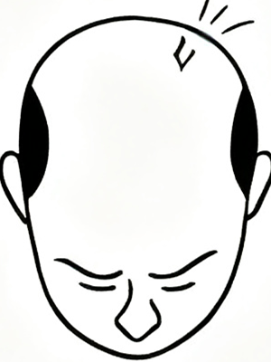 Stage 8 - Total hair loss
