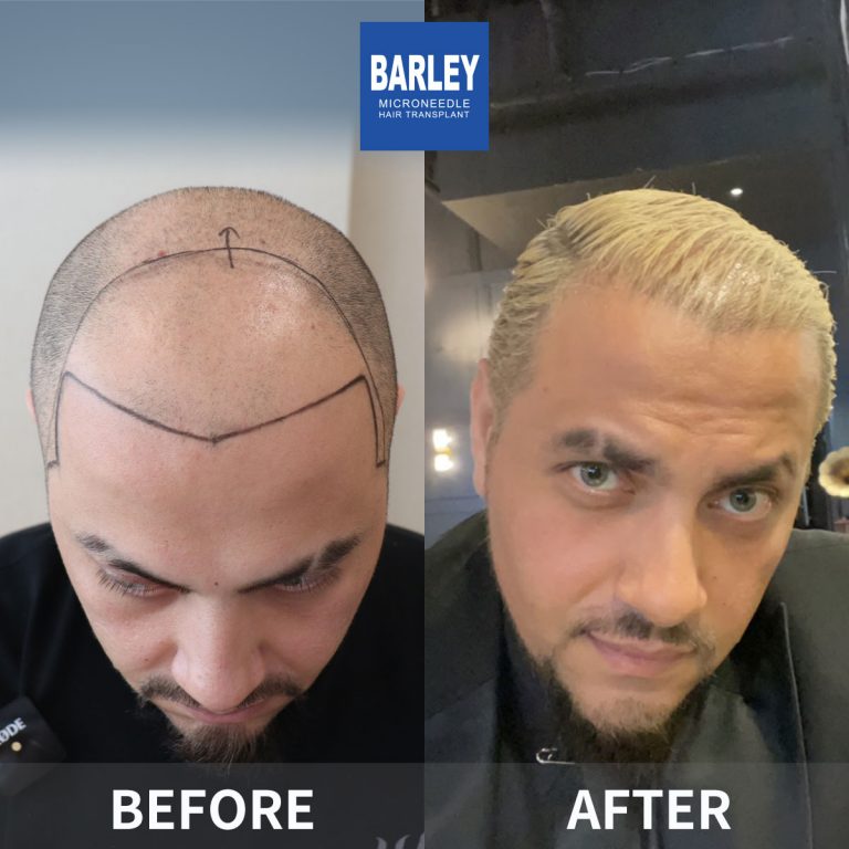 Scar hair transplant result 1