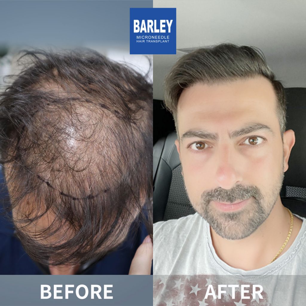 Scar hair transplant result 3