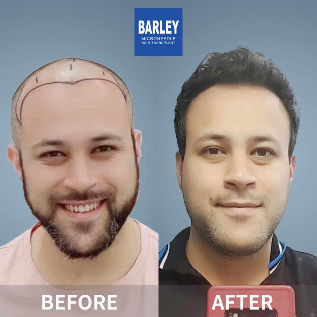 Scar hair transplant result 2