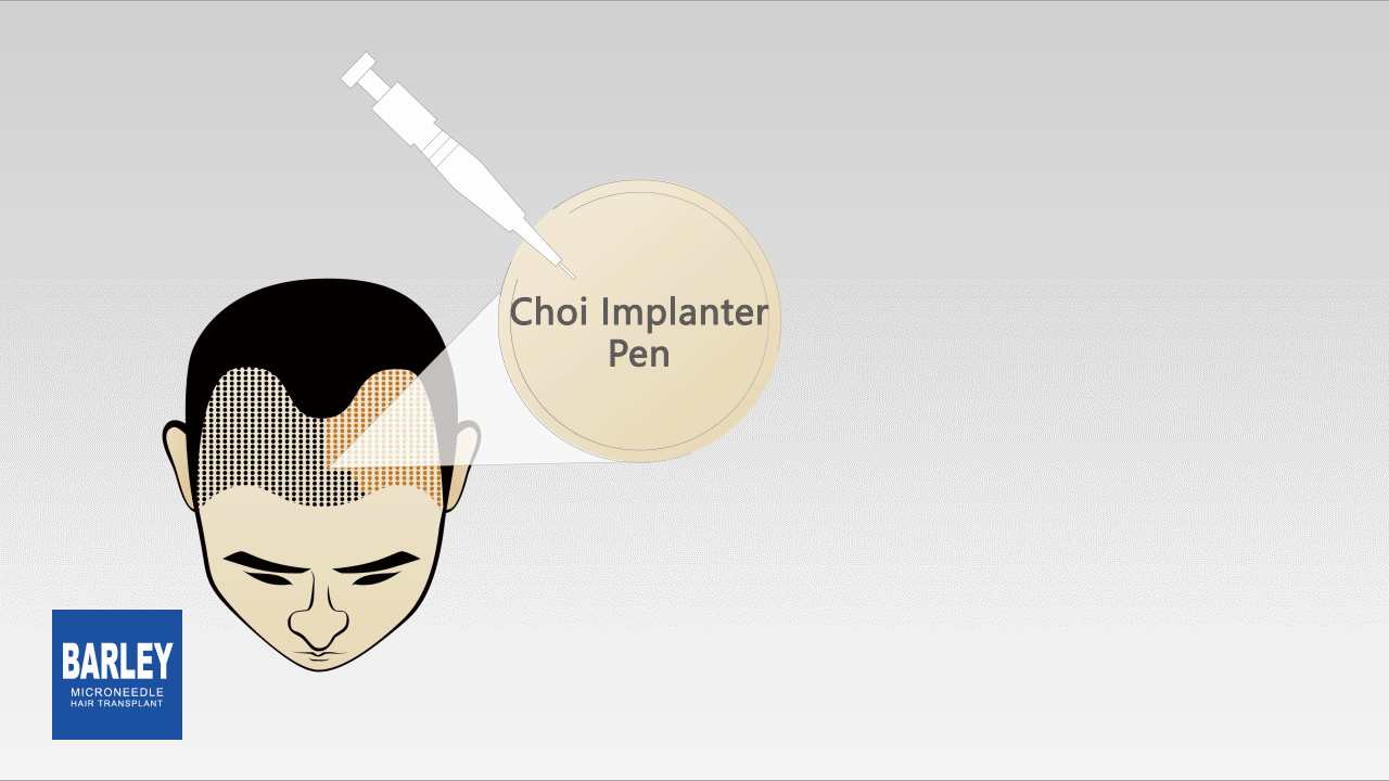 Microneedle hair transplant technology