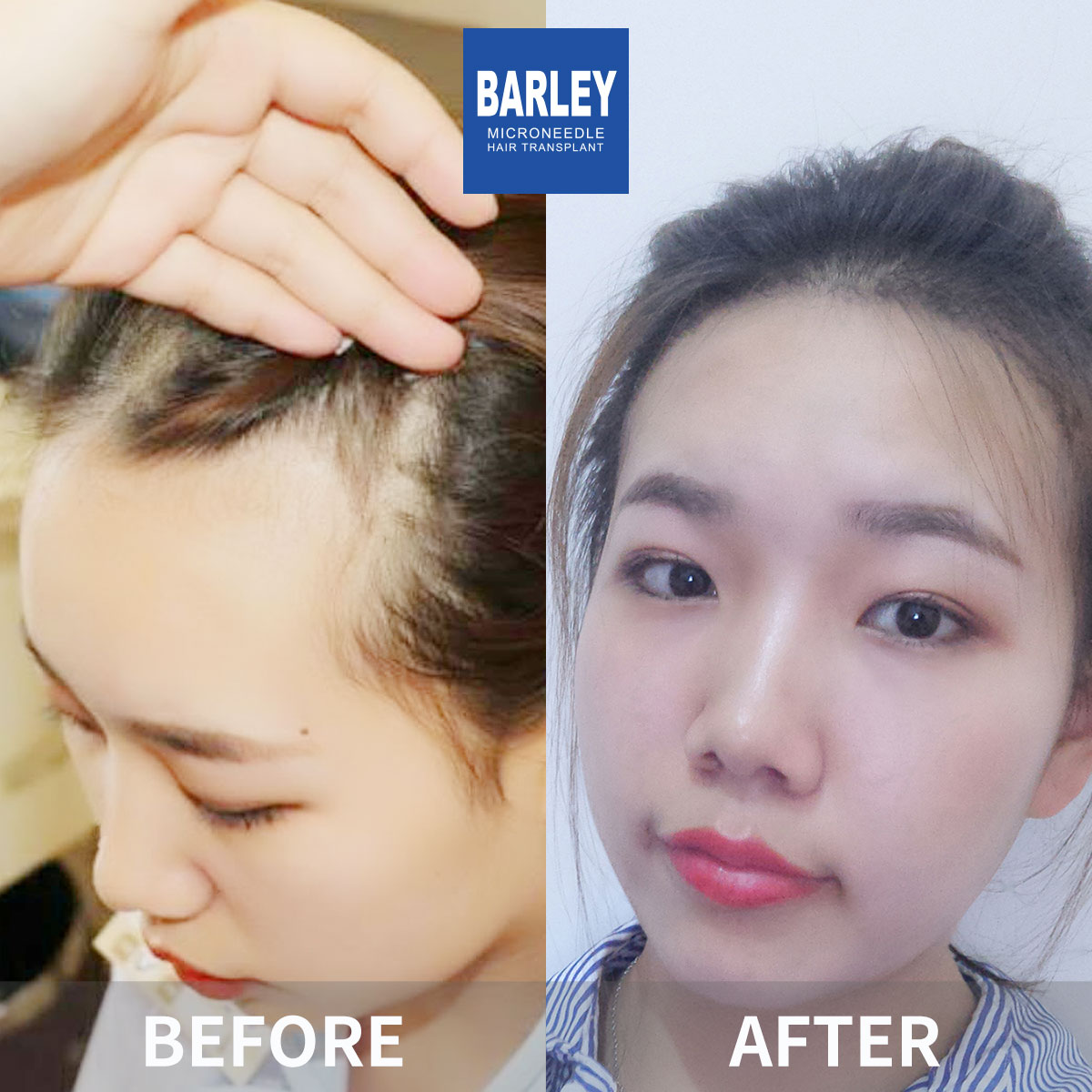 Female hair transplant before and after