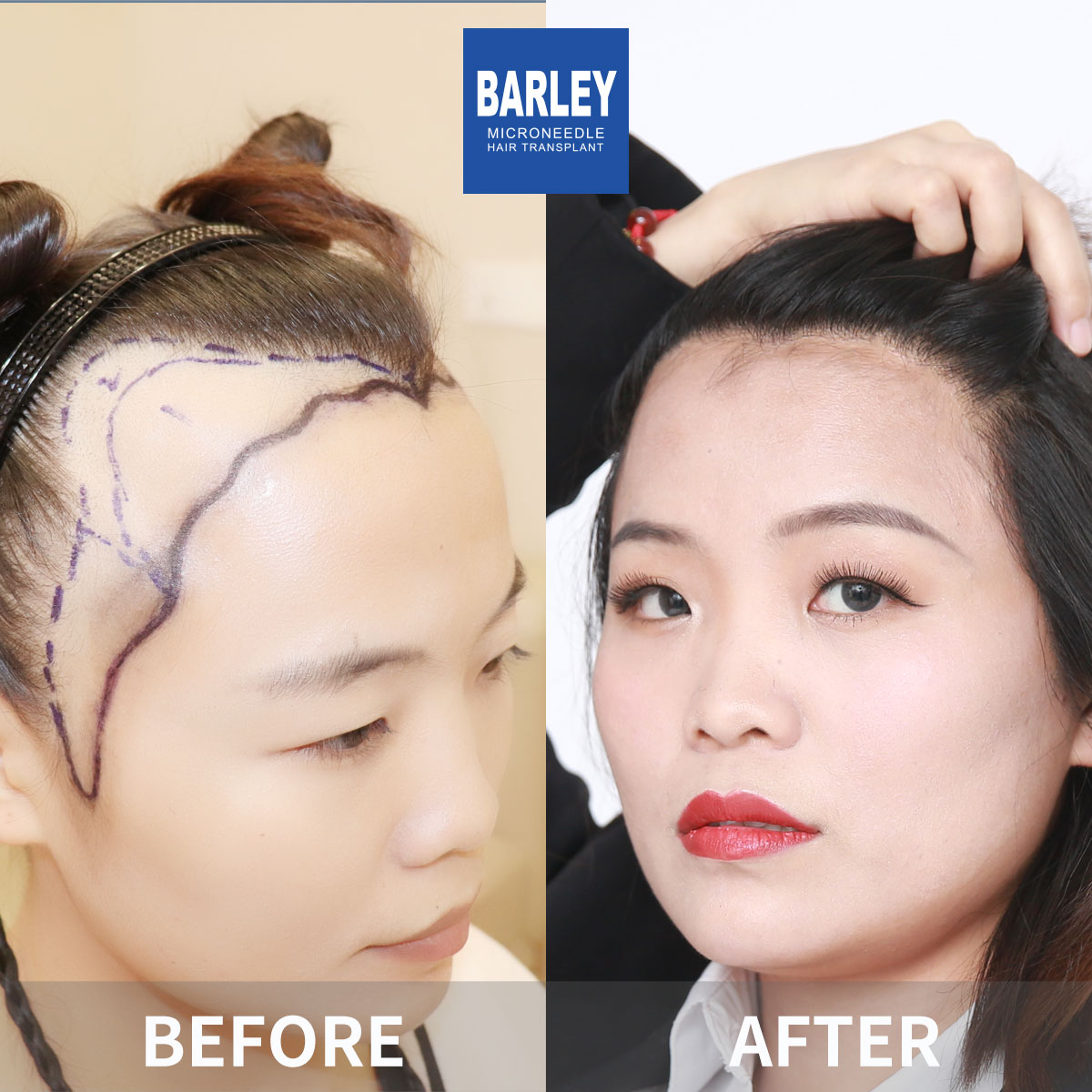 Female hair transplant before and after