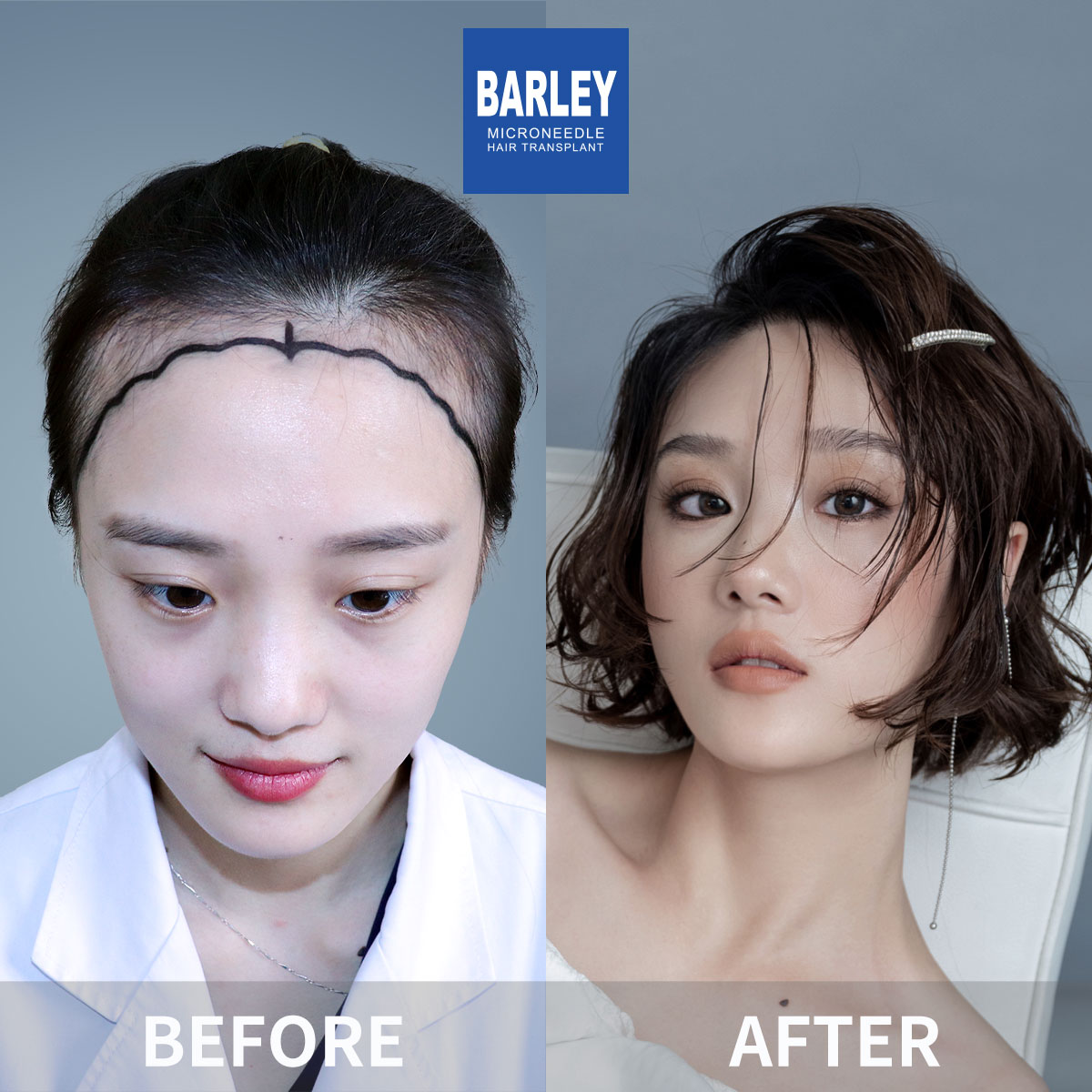 Female hair transplant before and after