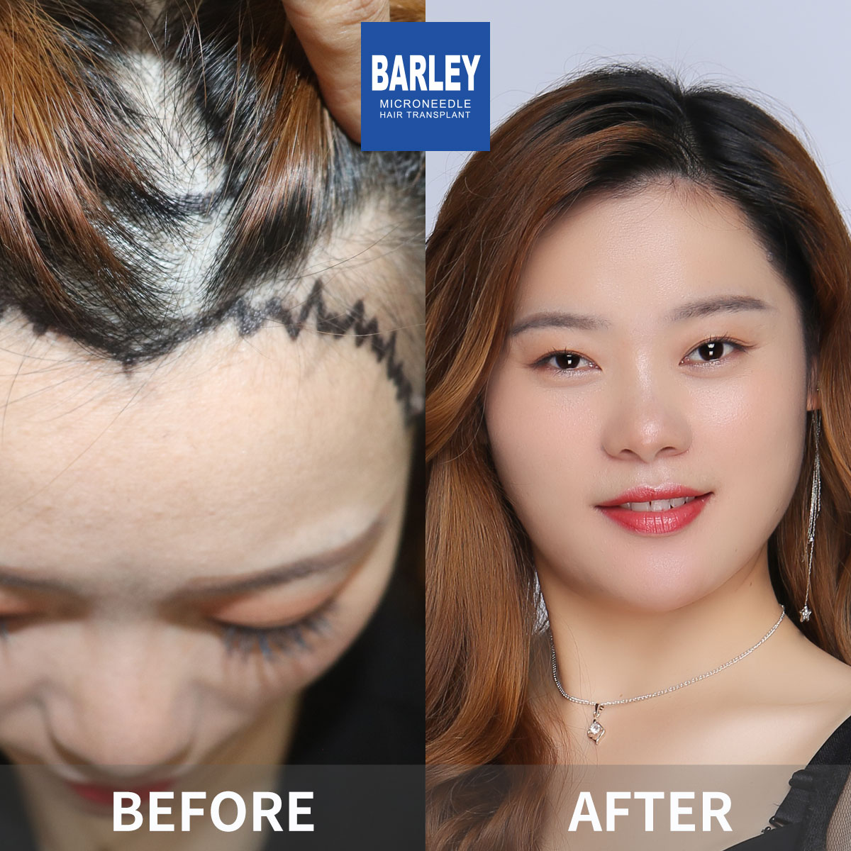 Female hair transplant before and after