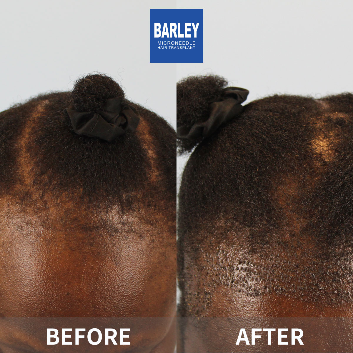 Female hair transplant results