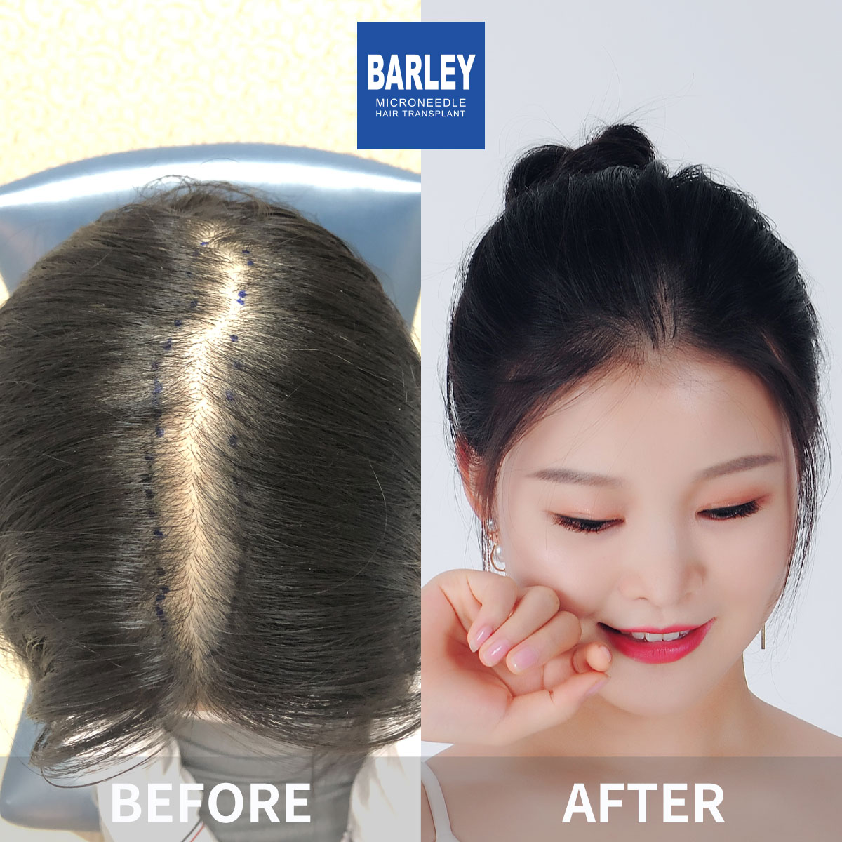 Female hair transplant before and after