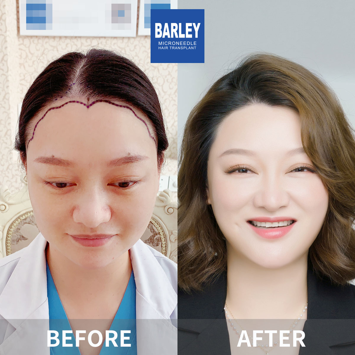Female hair transplant before and after