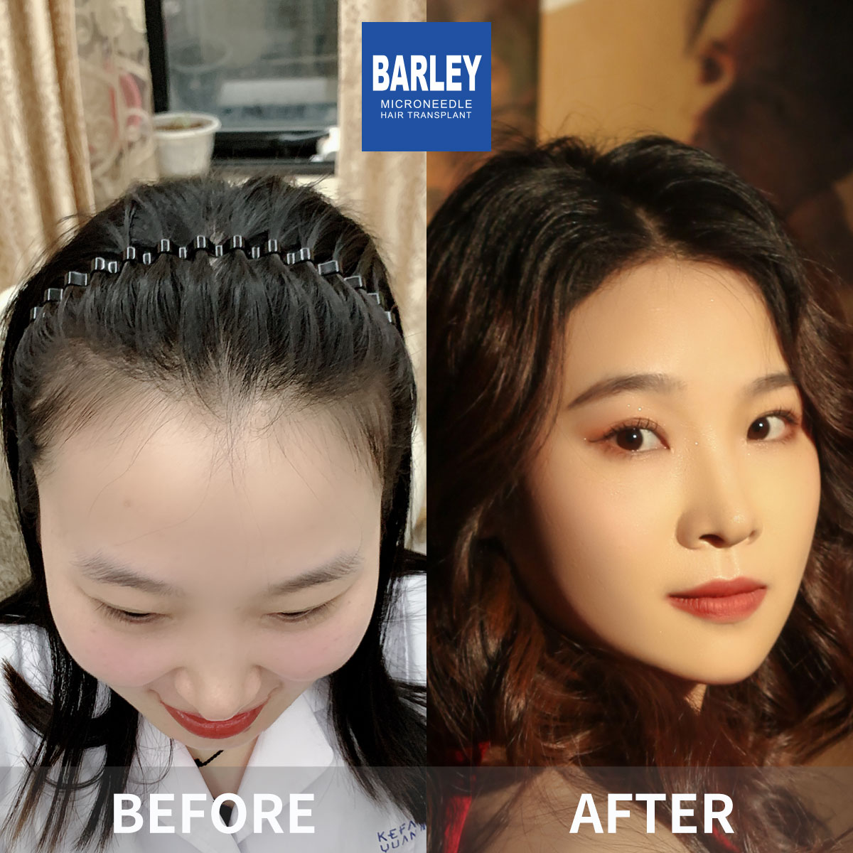 Female hair transplant before and after