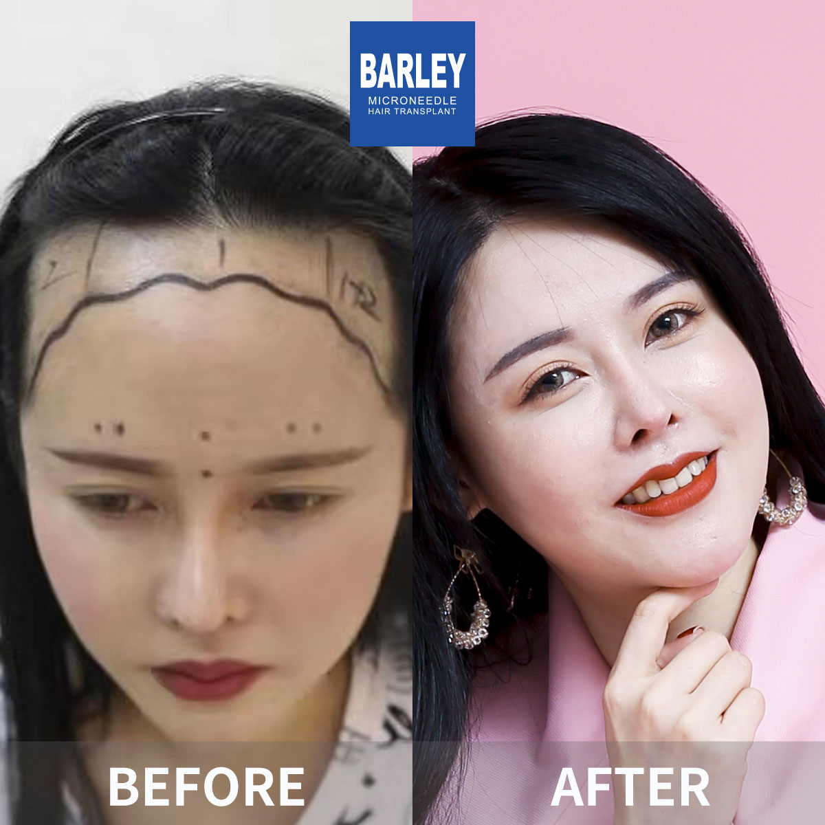 Female hair transplant before and after