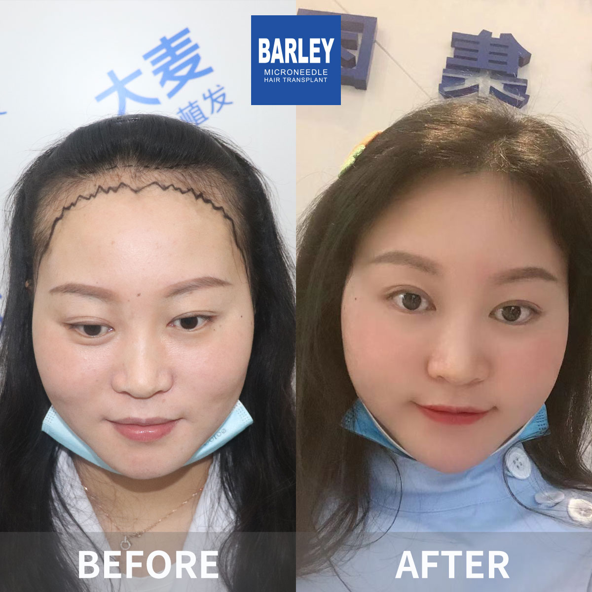 Female hair transplant before and after