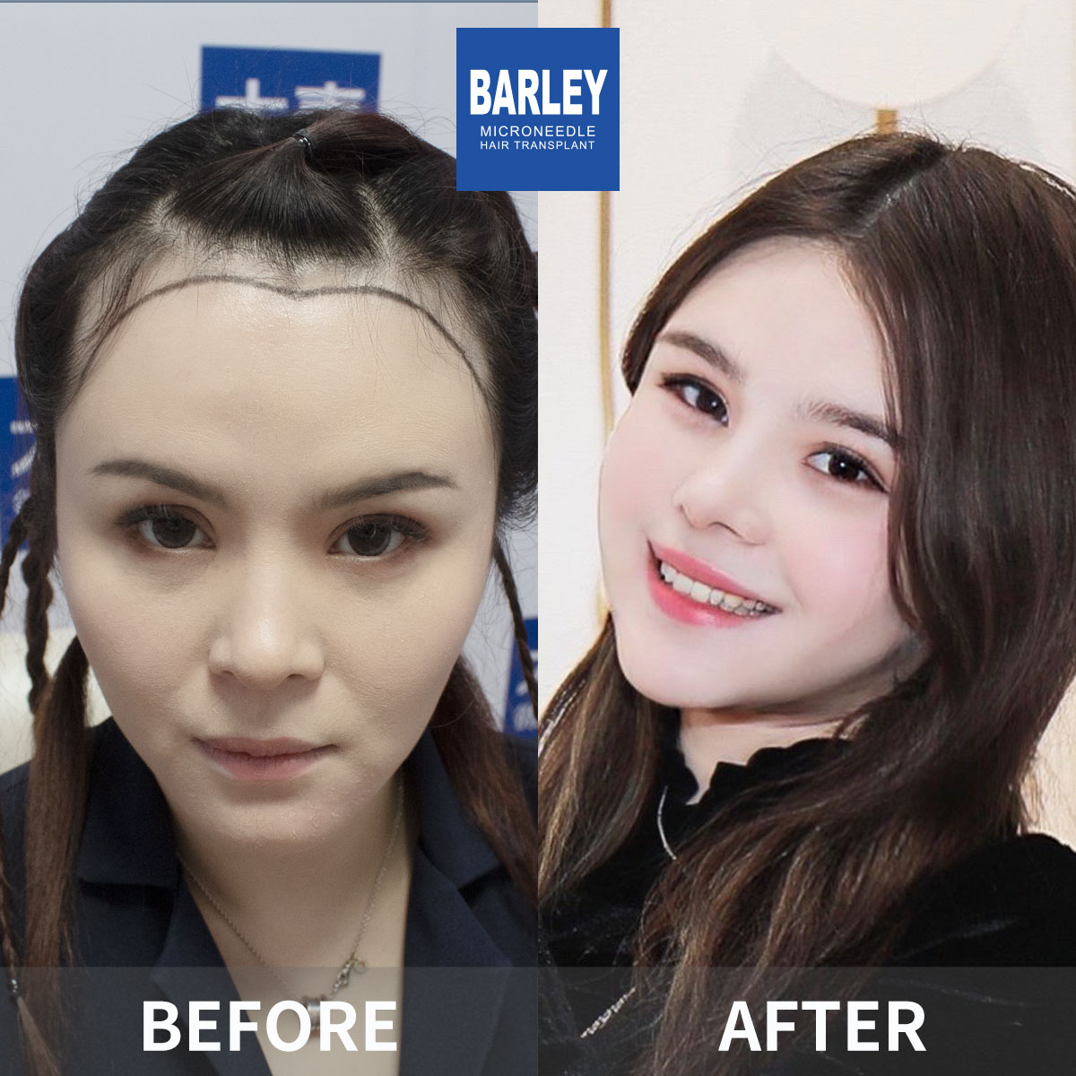 Female hair transplant before and after