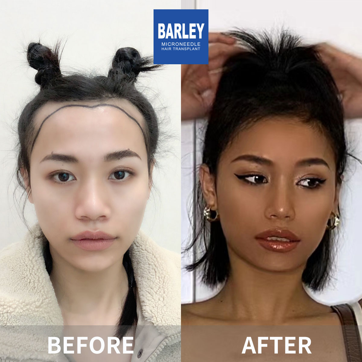 Female hair transplant before and after
