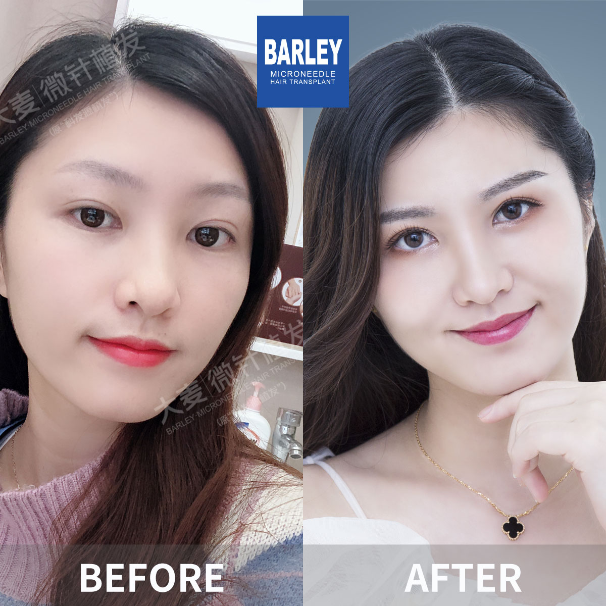 Female hair transplant before and after