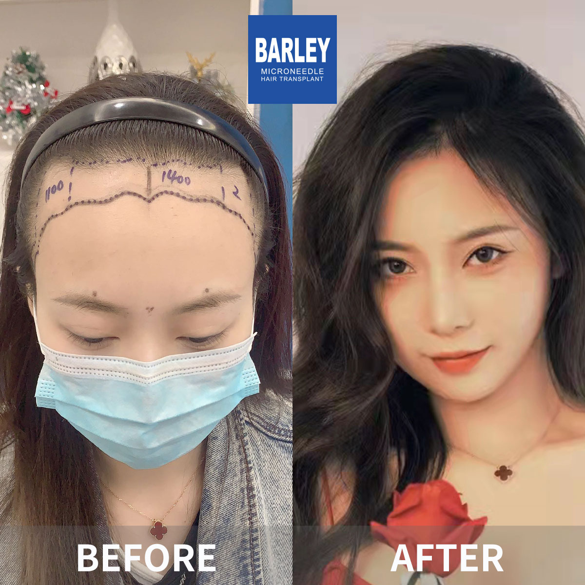 Female hair transplant before and after